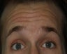 Botox