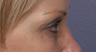 Eyelid Surgery