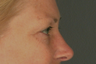 Eyelid Surgery