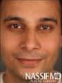 Indian Male Primary Rhinoplasty 
