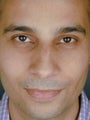 Indian Male Primary Rhinoplasty 