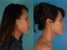 Asian Rhinoplasty