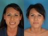 Asian Rhinoplasty