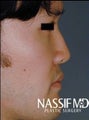 Asian Male Rhinoplasty 