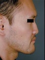 Asian Male Rhinoplasty 