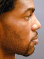 Male Chin Implant 