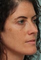 Sciton BBL and Microlaser peel - One Treatment,  2 weeks post op