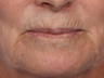 Botox