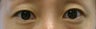 Bilateral Asian Eyelid Surgery