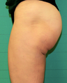 Exilis