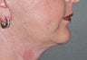 48 Year Old Female Treated For Sagging Neck and Jowls