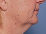 48 Year Old Female Treated For Sagging Neck and Jowls