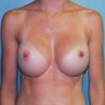 32-Year-Old Female Breast Augmentation