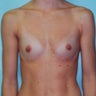 32-Year-Old Female Breast Augmentation