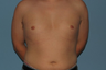 VASER LipoSelection performed on his chest