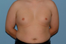 VASER LipoSelection performed on his chest