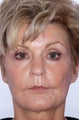 Facelift