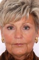 Facelift