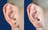 Stretched Earlobe Repair
