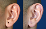 Stretched Earlobe Repair