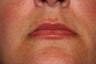 Lip Augmentation