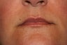 Lip Augmentation