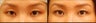 Asian Eyelid Surgery for Uneven Crease