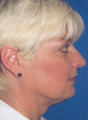 Neck Liposuction