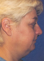 Neck Liposuction