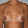 Revision Breast Implants Augmentation Enlargement Enhancement