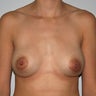 Revision Breast Implants Augmentation Enlargement Enhancement