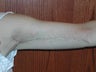 45 year old woman has Arm Lift Surgery