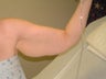 45 year old woman has Arm Lift Surgery