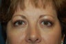 Eyelid Surgery