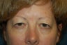 Eyelid Surgery