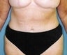 62 year old female patient 