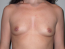 40 year old for breast augmentation.