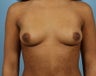 Breast Augmentation