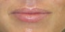 27 year old undergoing lip augmentation