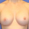 Breast Augmentation Revised