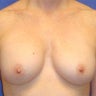 Breast Augmentation Revised
