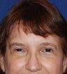 Caucasian Female Underwent Browlift 