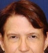 Caucasian Female Underwent Browlift 