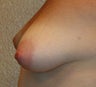 Breast Augmentation