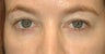 Fat Transfer Injections to tear trough regions around the eyes
