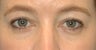 Fat Transfer Injections to tear trough regions around the eyes