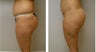 Brazilian Butt Lift 