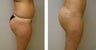 Brazilian Butt Lift 