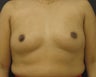 Tummy Tuck and Breast Augmentation (Mommy Makeover)