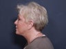 Neck Lift